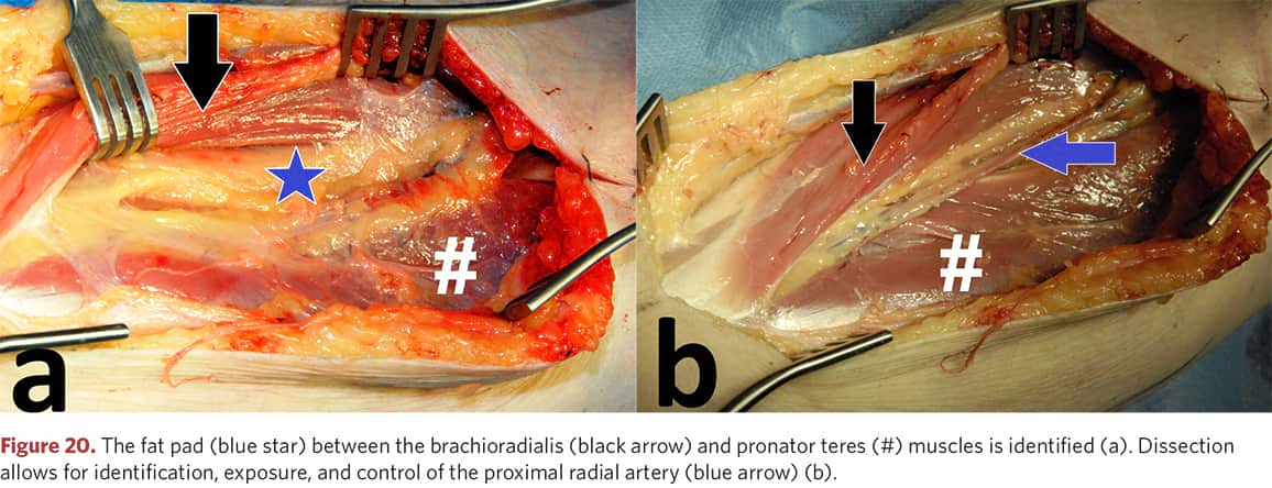 Proximal part of the radial artery