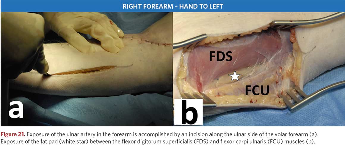 Surgical access to the ulnar artery on the forearm