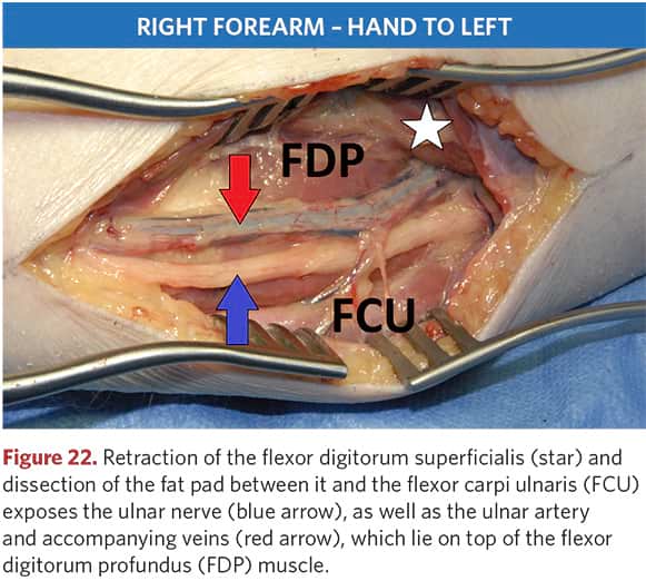 Ulnar nerve, artery and associated veins