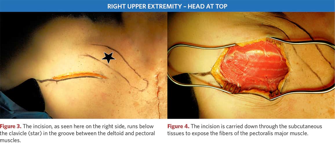 Subcutaneous tissue incision to access the pectoralis major muscle