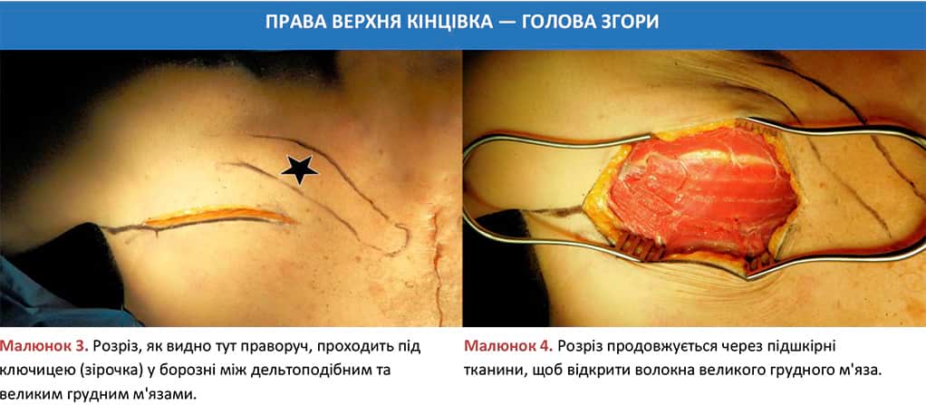 Розріз підшкірних тканин для доступу до великого грудного м'яза