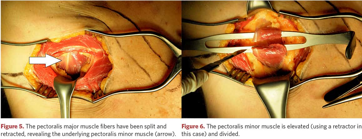 Incision of the pectoralis major muscle to access the pectoralis minor muscle