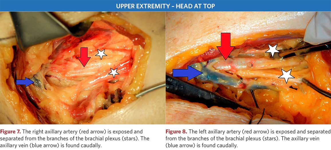 Image of the section: right and left axillary arteries and veins