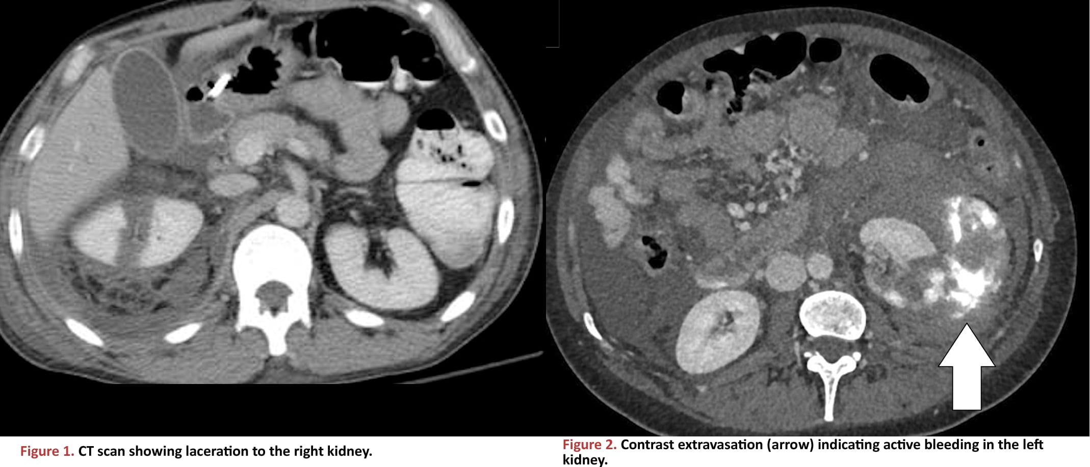 CT scan showing laceration to the right kidney