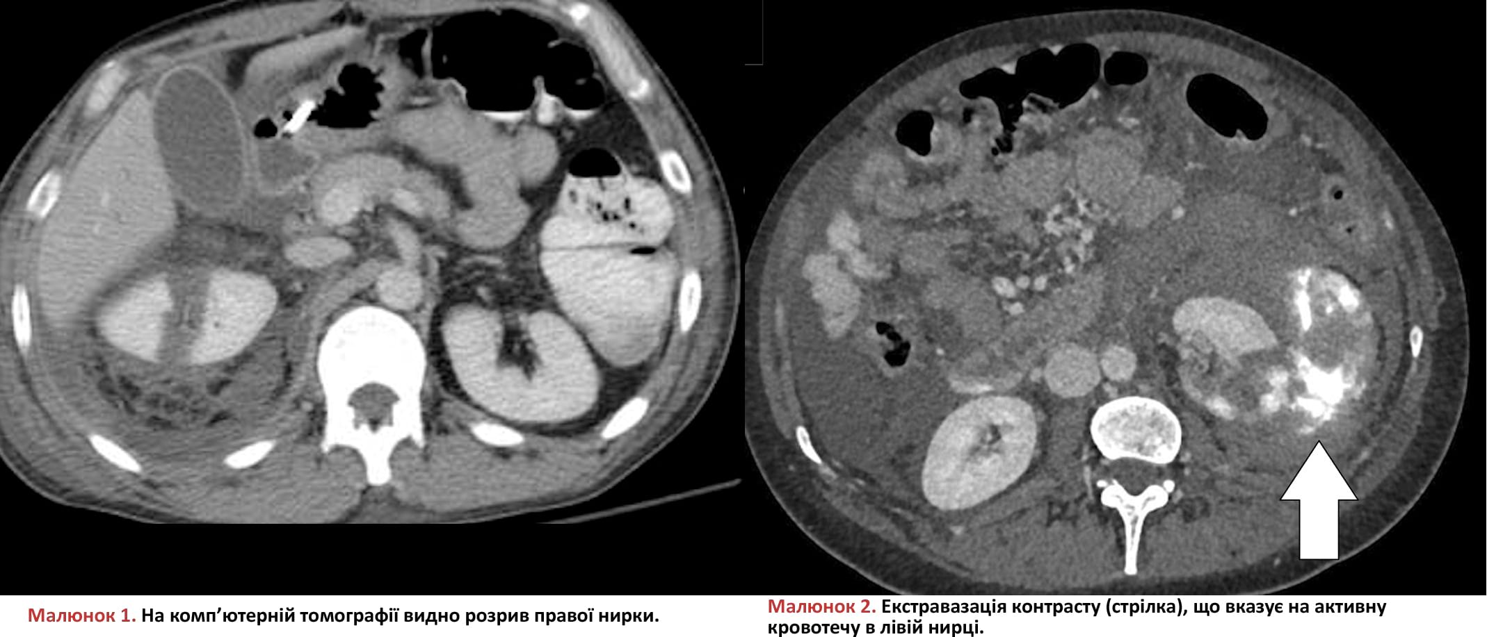 На комп’ютерній томографії видно розрив правої нирки