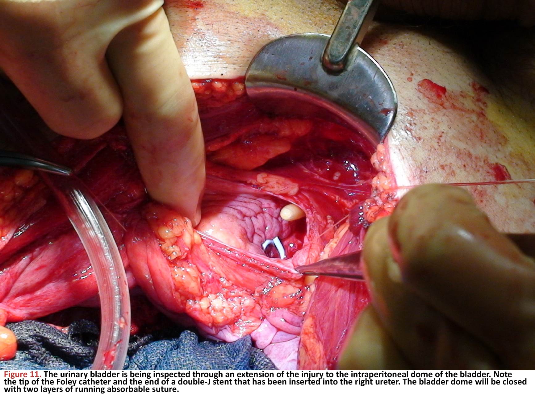 The urinary bladder is being inspected through an extension of the injury to the intraperitoneal dome of the bladder