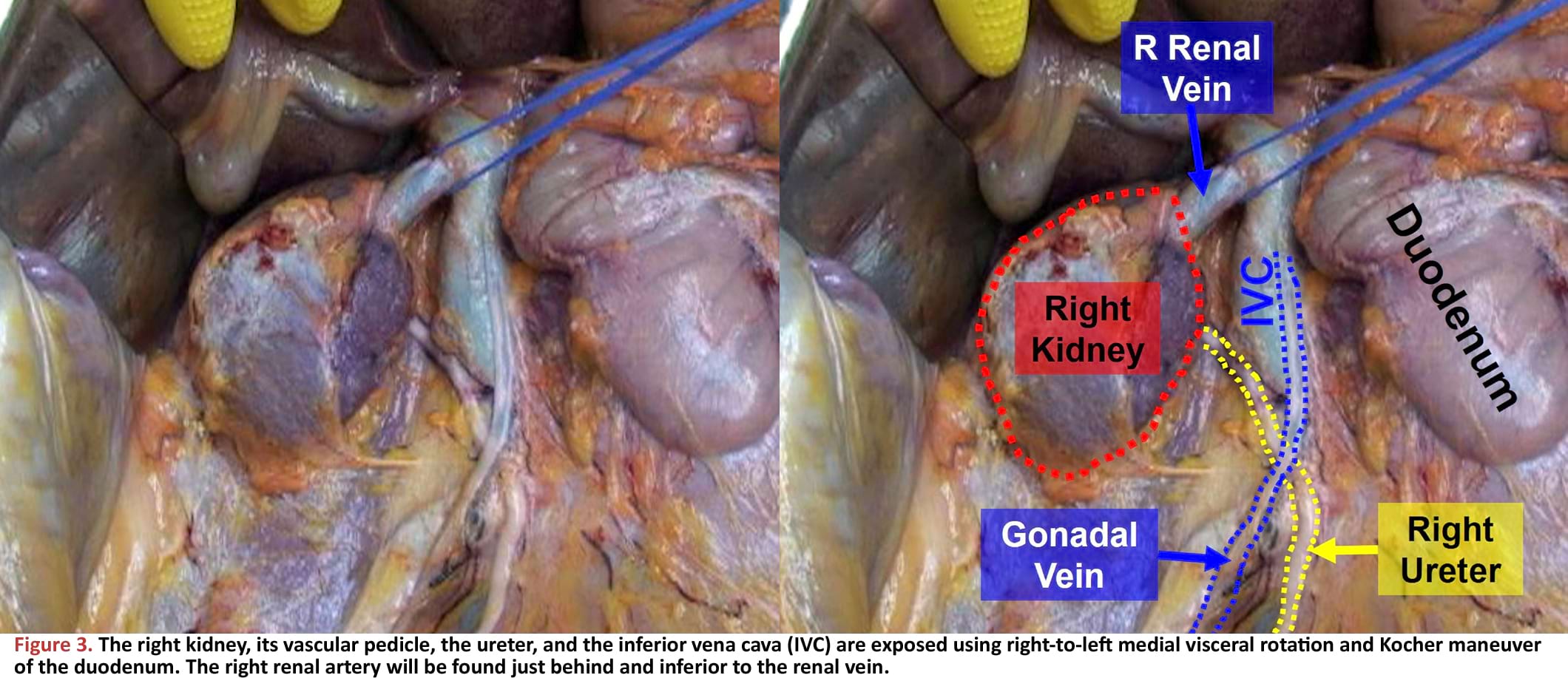 The right kidney, its vascular pedicle, the ureter, and the inferior vena cava (IVC) are exposed using right-to-left medial visceral rotation