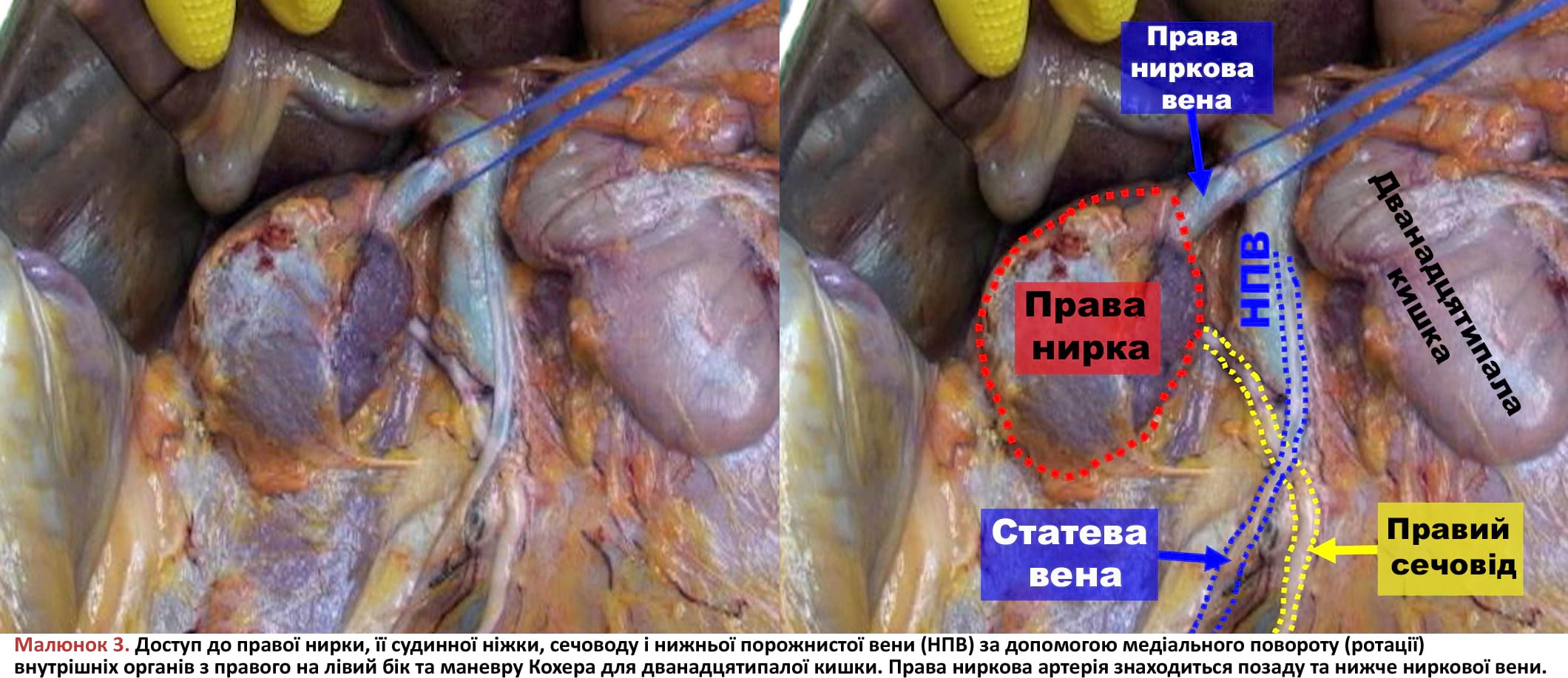 Доступ до правої нирки, її судинної ніжки, сечоводу і нижньої порожнистої вени (НПВ) за допомогою медіального повороту