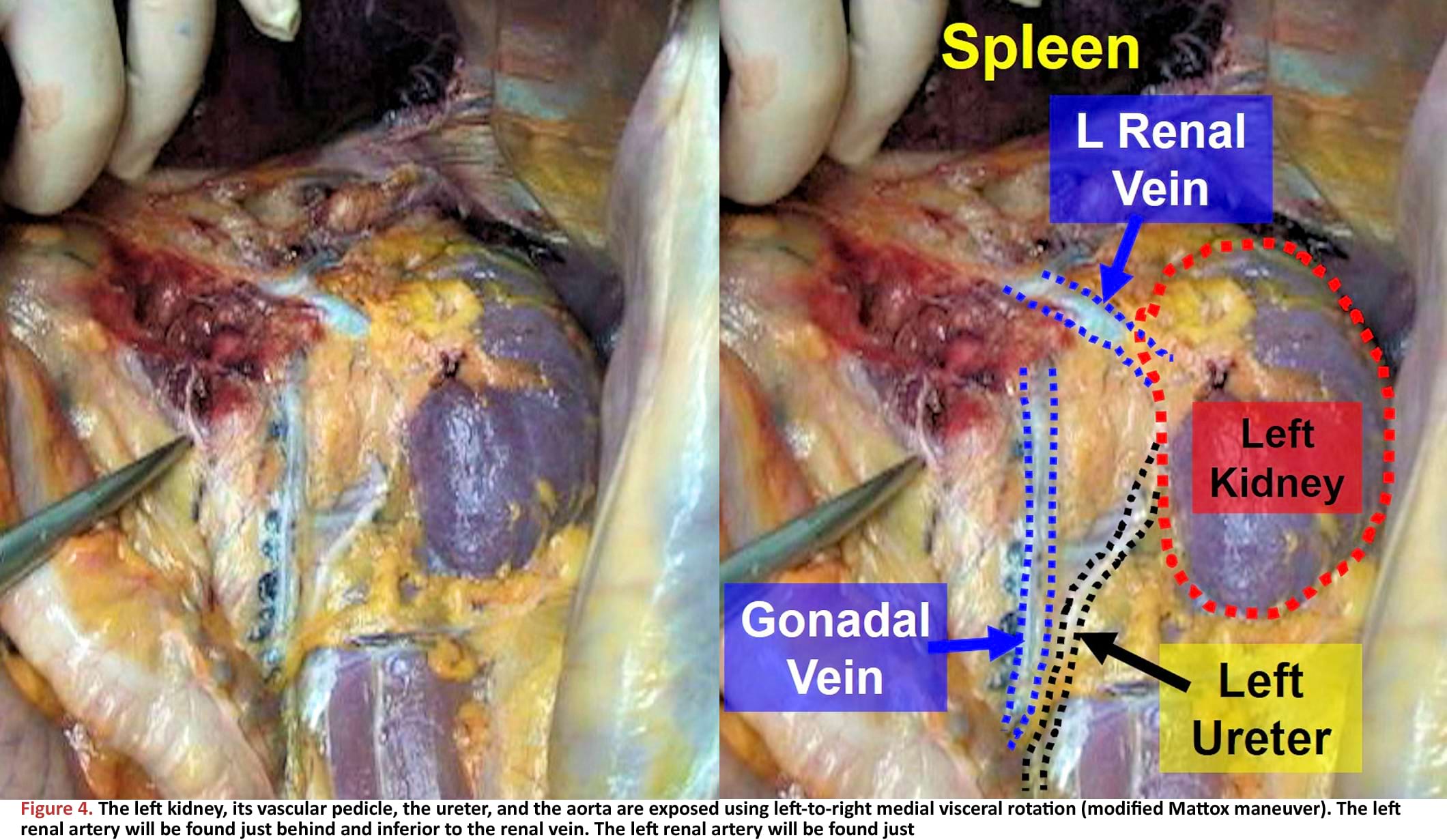 The left kidney, its vascular pedicle, the ureter, and the aorta are exposed using left-to-right medial visceral rotation