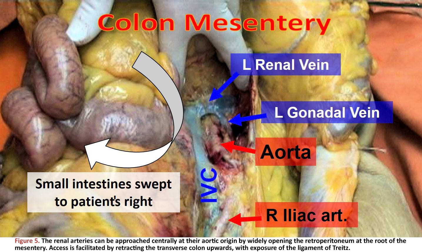 The renal arteries can be approached centrally at their aortic origin by widely opening the retroperitoneum at the root of the mesentery