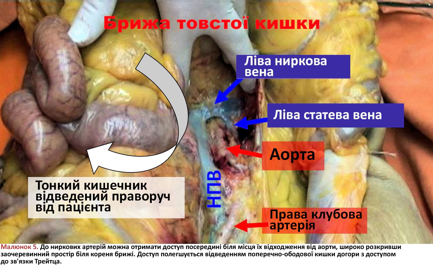 До ниркових артерій можна отримати доступ посередині біля місця їх відходження від аорти, широко розкривши заочеревинний простір біля кореня брижі