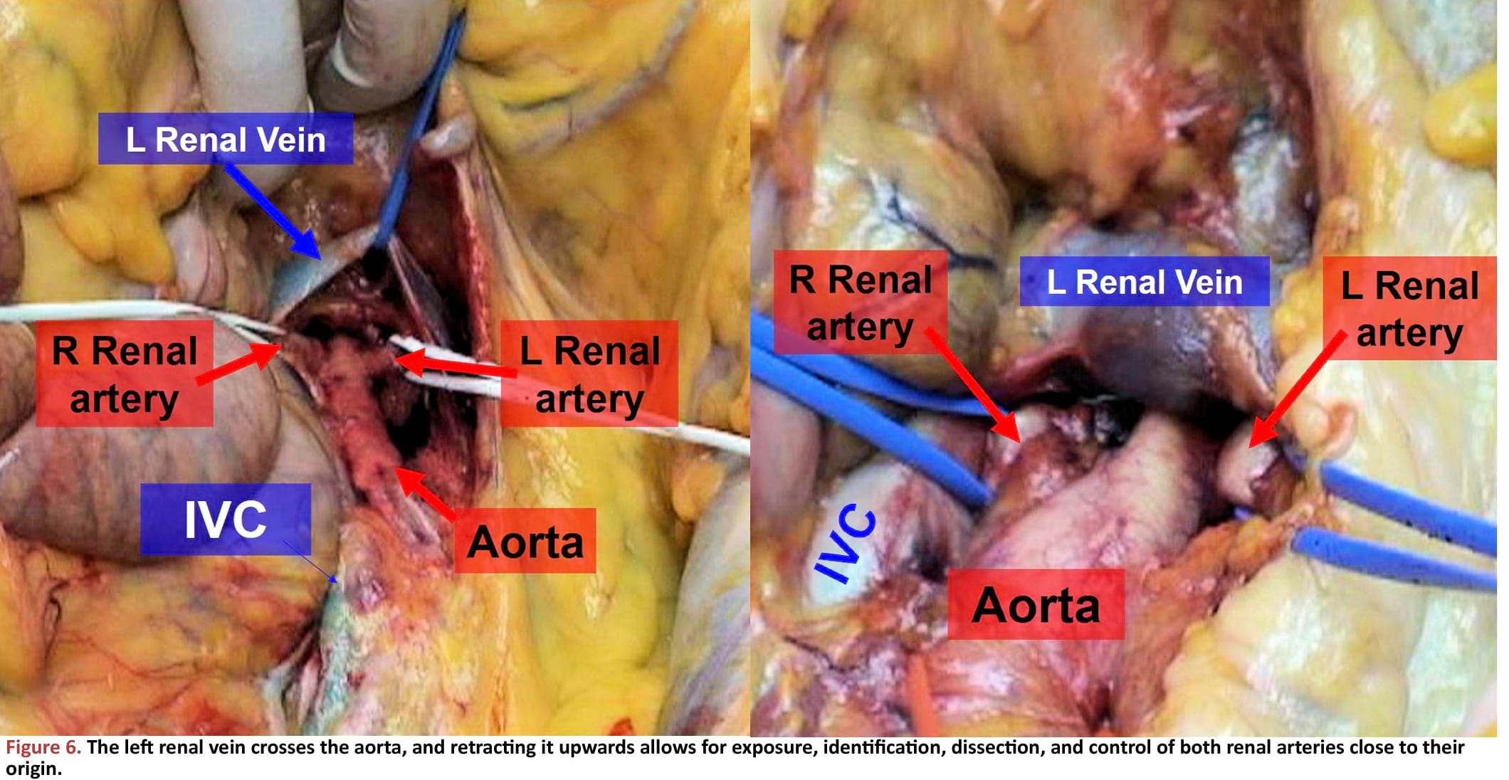 The left renal vein crosses the aorta