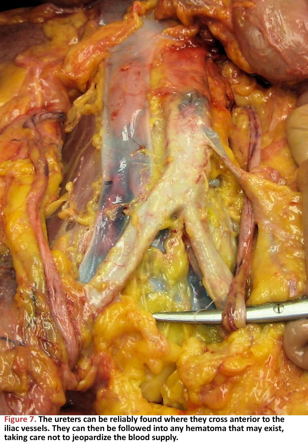 The ureters can be reliably found where they cross anterior to the iliac vessels