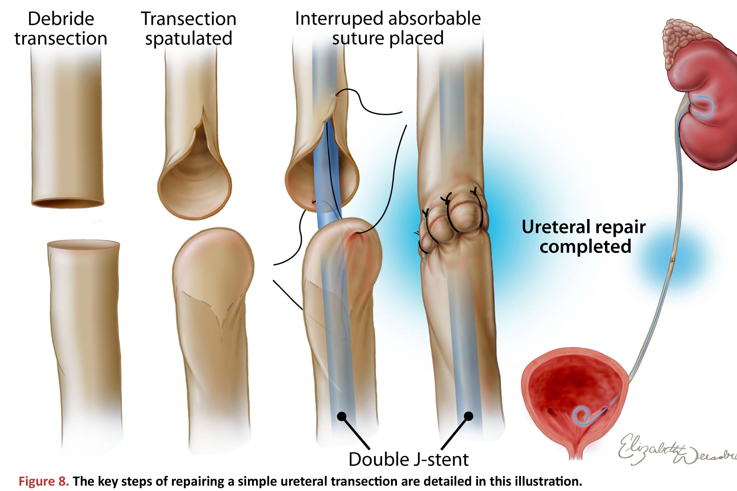 The key steps of repairing a simple ureteral transection are detailed in this illustration