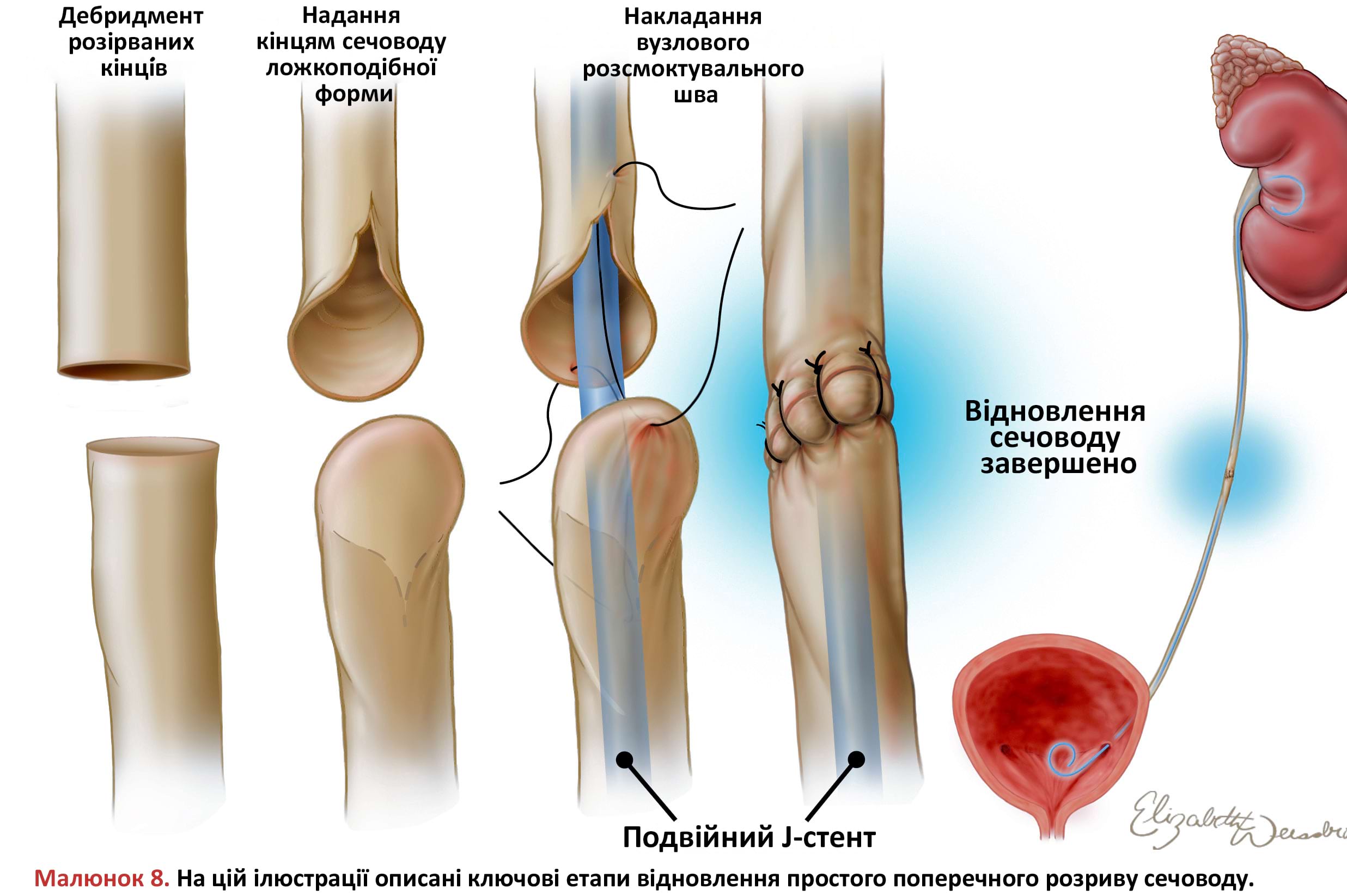 Ключові етапи відновлення простого поперечного розриву сечоводу