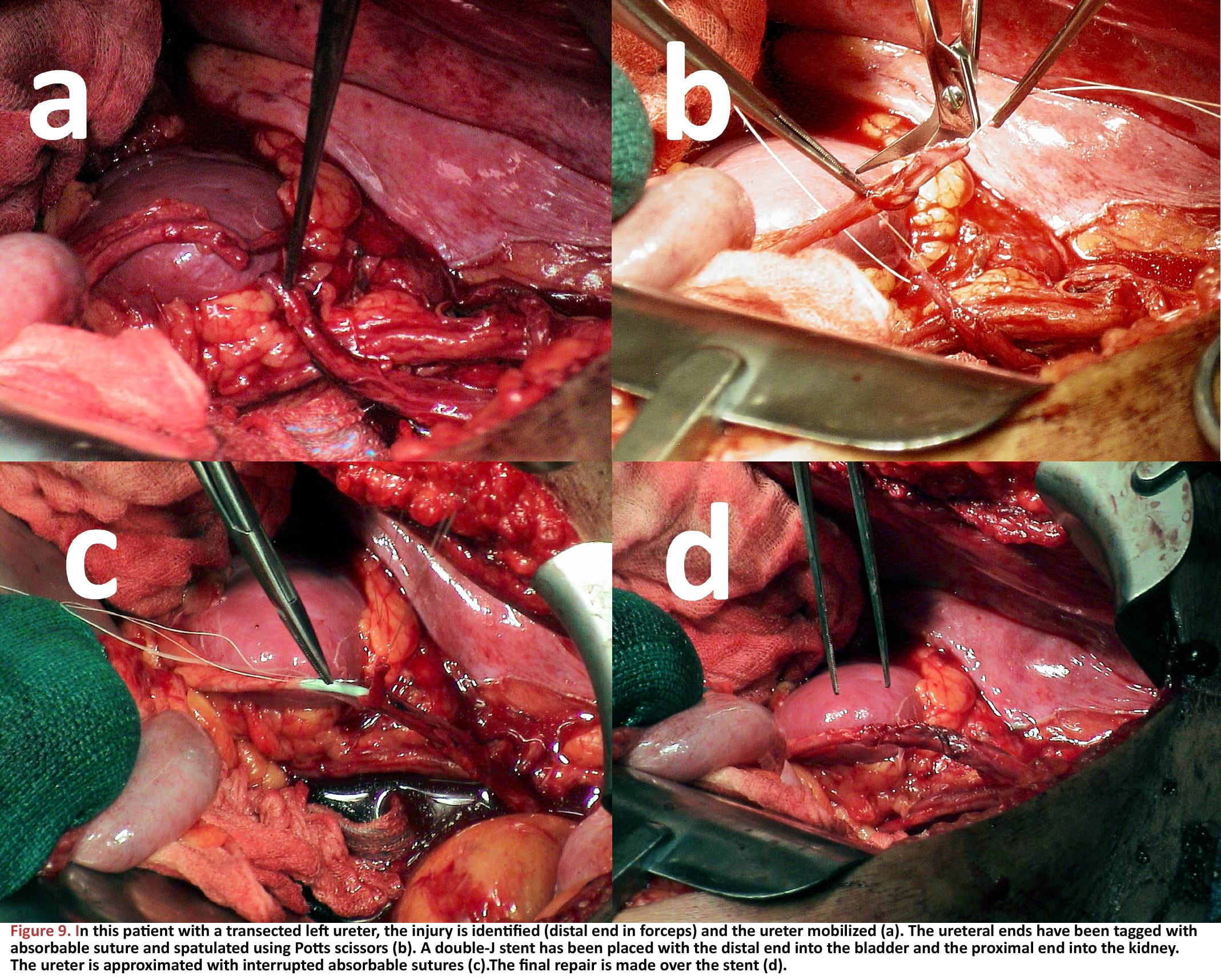 In this patient with a transected left ureter, the injury is identified (distal end in forceps) and the ureter mobilized (a)