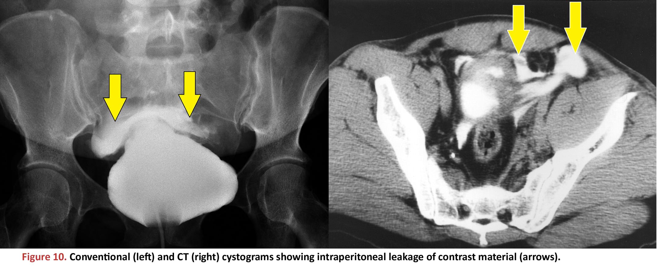 Conventional (left) and CT (right) cystograms showing intraperitoneal leakage of contrast material (arrows)