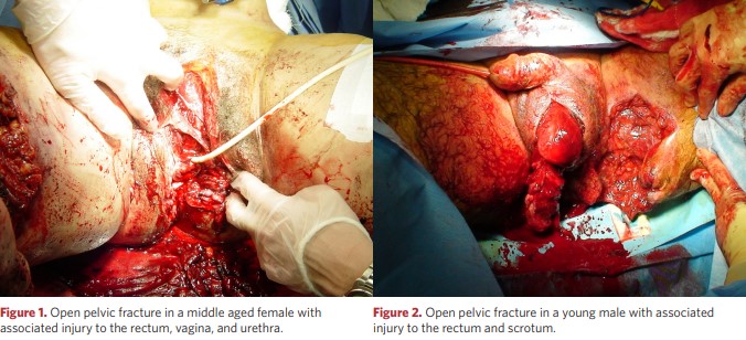 Open pelvic fracture in a woman and a man