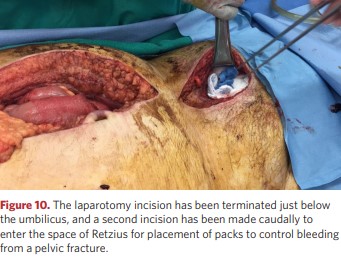 . The laparotomy incision has been terminated just below the umbilicus