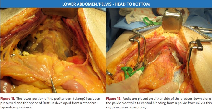 The lower portion of the peritoneum (clamp)