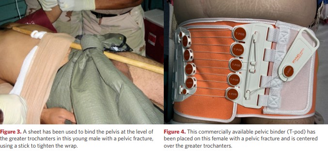 Fracture of the pelvic bones, pelvic binder