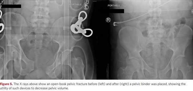 The X-ray shows a pelvic fracture