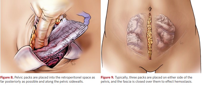 . Pelvic packs are placed into the retroperitonel space