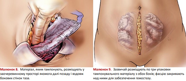 Матеріал, яким тампонують, розміщують у заочеревинному просторі