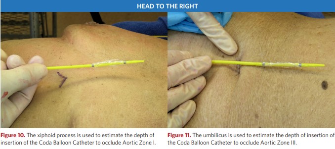 Assessment of the depth of insertion of the Coda balloon catheter