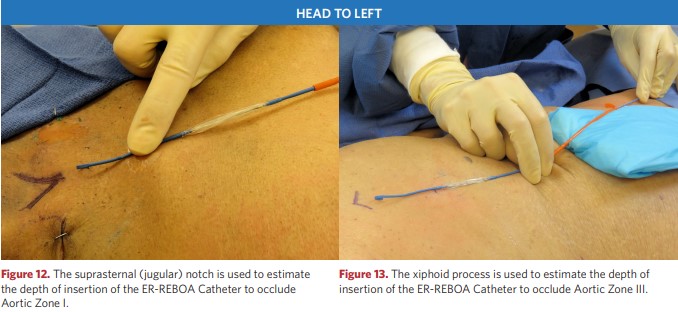 Assessment of the depth of insertion of the ER-REBOA catheter