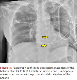 Radiograph: ER-REBOA Catheter in Aortic Zone I