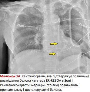 Рентгенограма: ER-REBOA в Зоні I