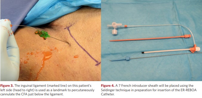 The inguinal ligament (marked line)