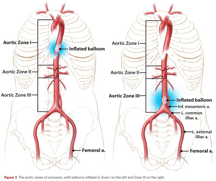 . The aortic zones of occlusion, with balloons inflated in Zone I on the left and Zone III on the right