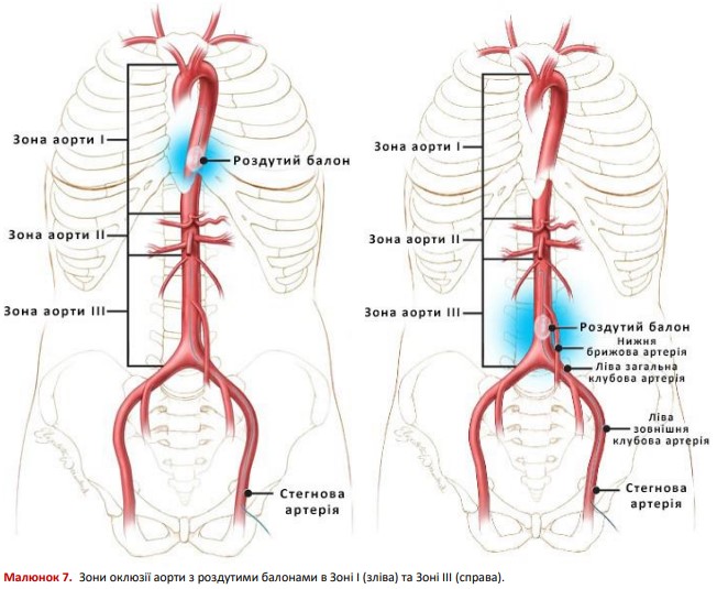 Зони оклюзії аорти з роздутими балонами в Зоні I (зліва) та Зоні III (справа)