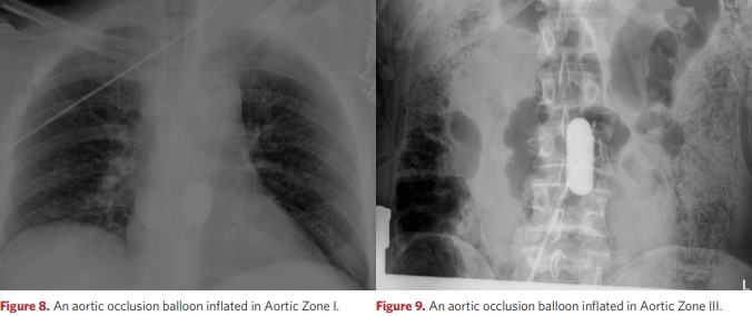 An aortic occlusion balloon inflated in Aortic Zone I and Zone III