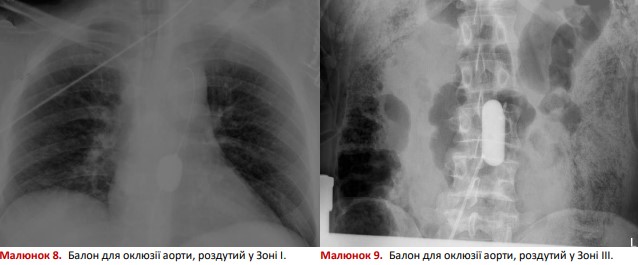 Балон для оклюзії аорти, роздутий у Зоні I та Зоні III