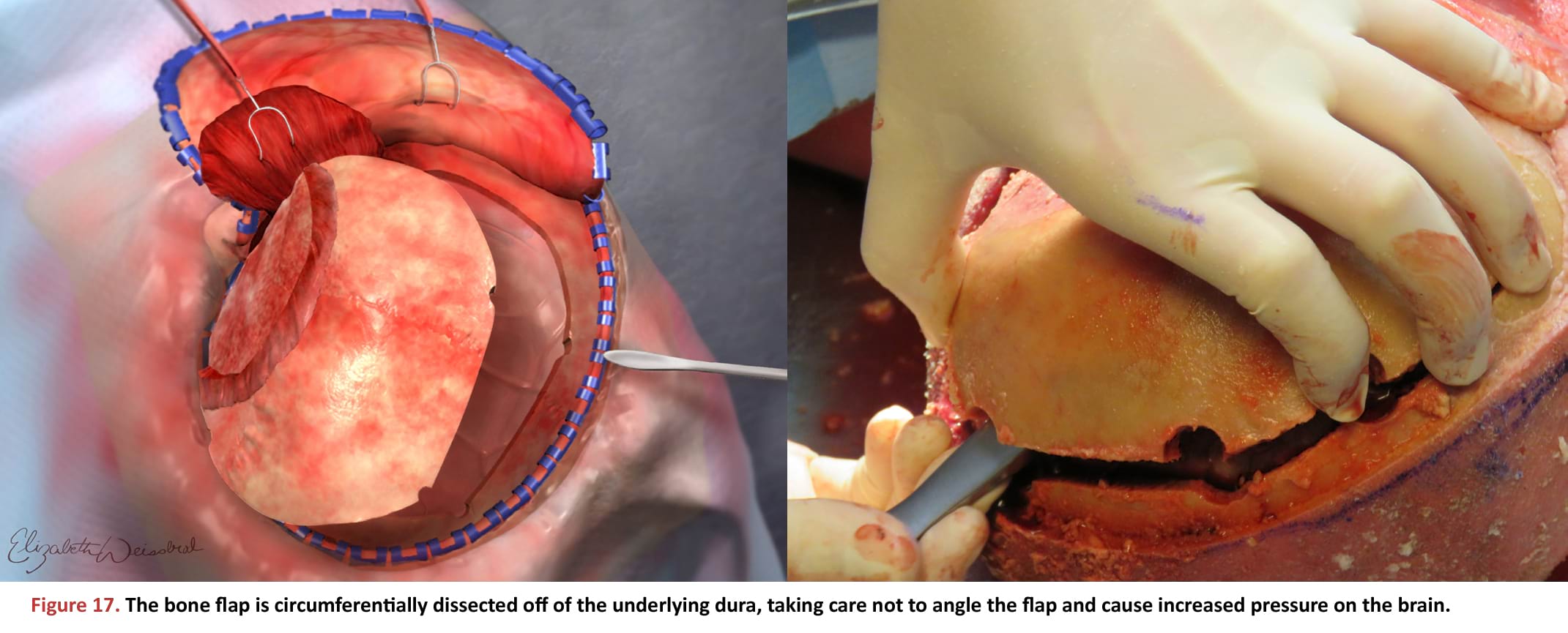 The bone flap is circumferentially dissected off of the underlying dura, taking care not to angle the flap and cause increased pressure on the brain