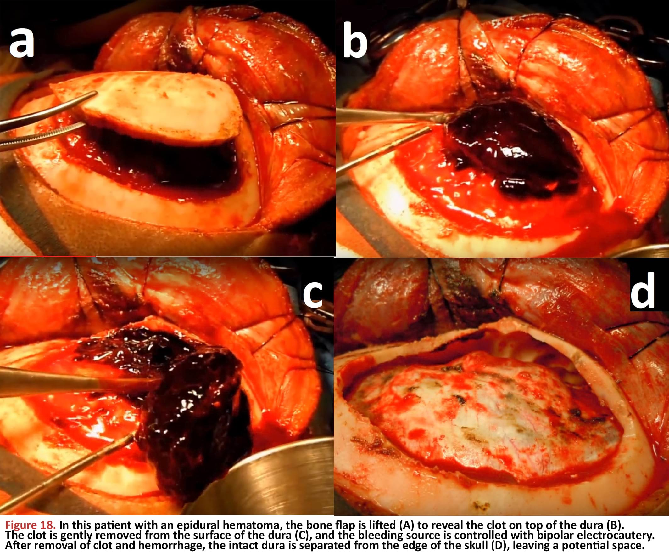 In this patient with an epidural hematoma, the bone flap is lifted to reveal the clot on top of the dura