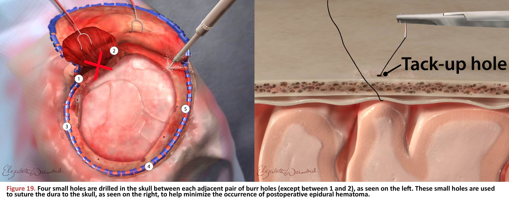 Four small holes are drilled in the skull between each adjacent pair of burr holes (except between 1 and 2), as seen on the left