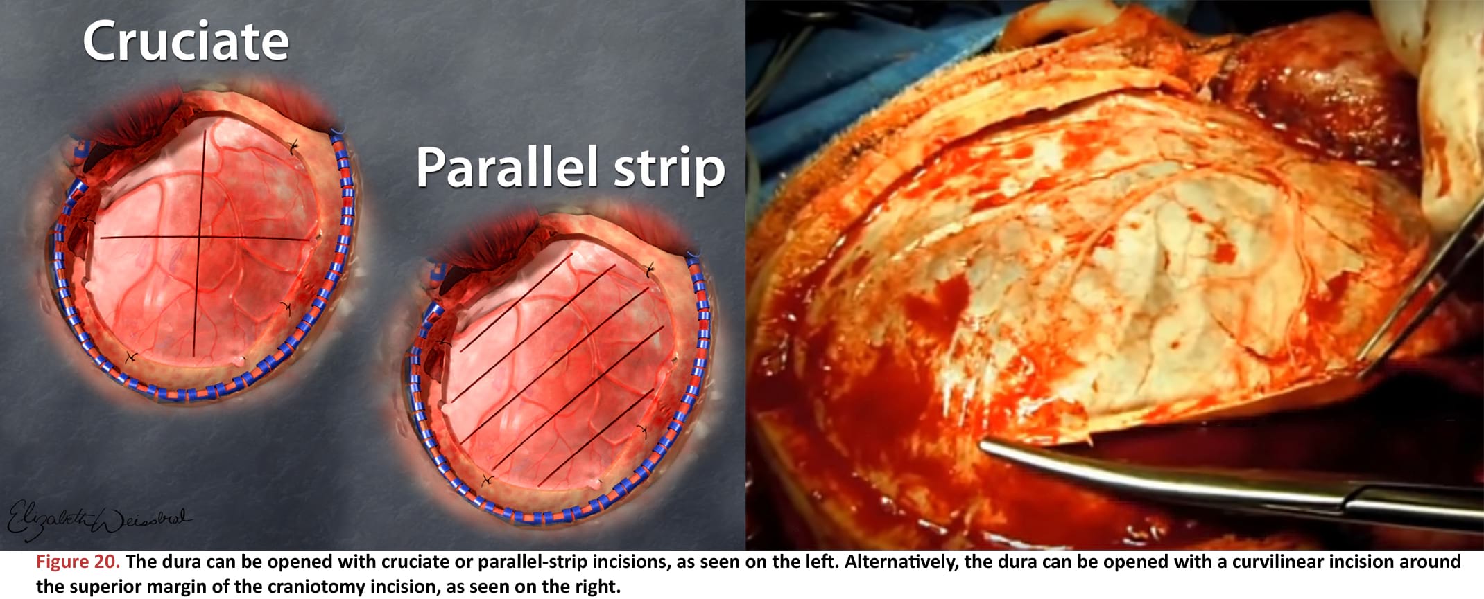 The dura can be opened with cruciate or parallel-strip incisions, as seen on the left