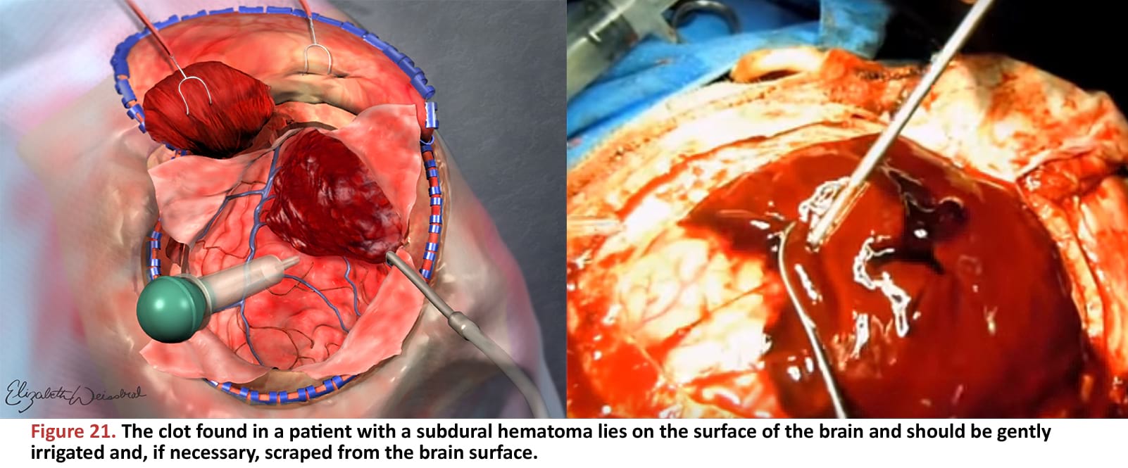 The clot found in a patient with a subdural hematoma lies on the surface of the brain and should be gently irrigated