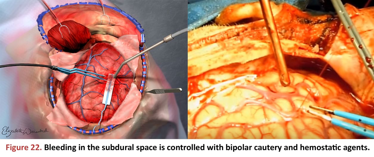 Bleeding in the subdural space is controlled with bipolar cautery and hemostatic agents