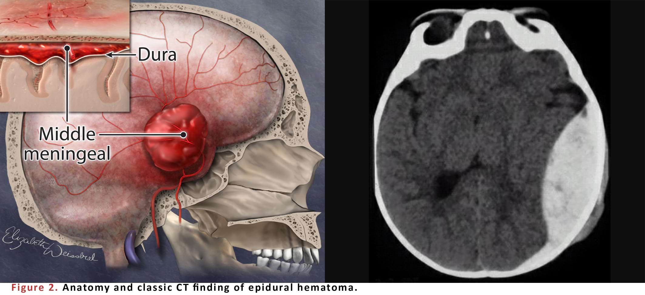 Anatomy and classic CT finding of epidural hematoma