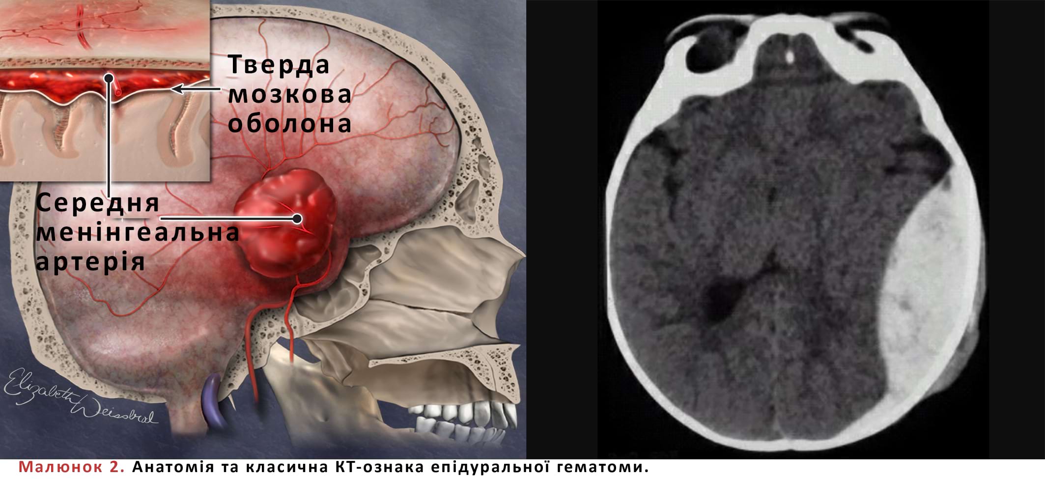 Анатомія та класична КТ-ознака епідуральної гематоми