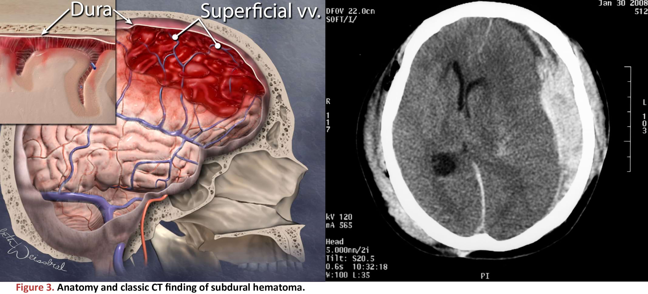 Anatomy and classic CT finding of subdural hematoma