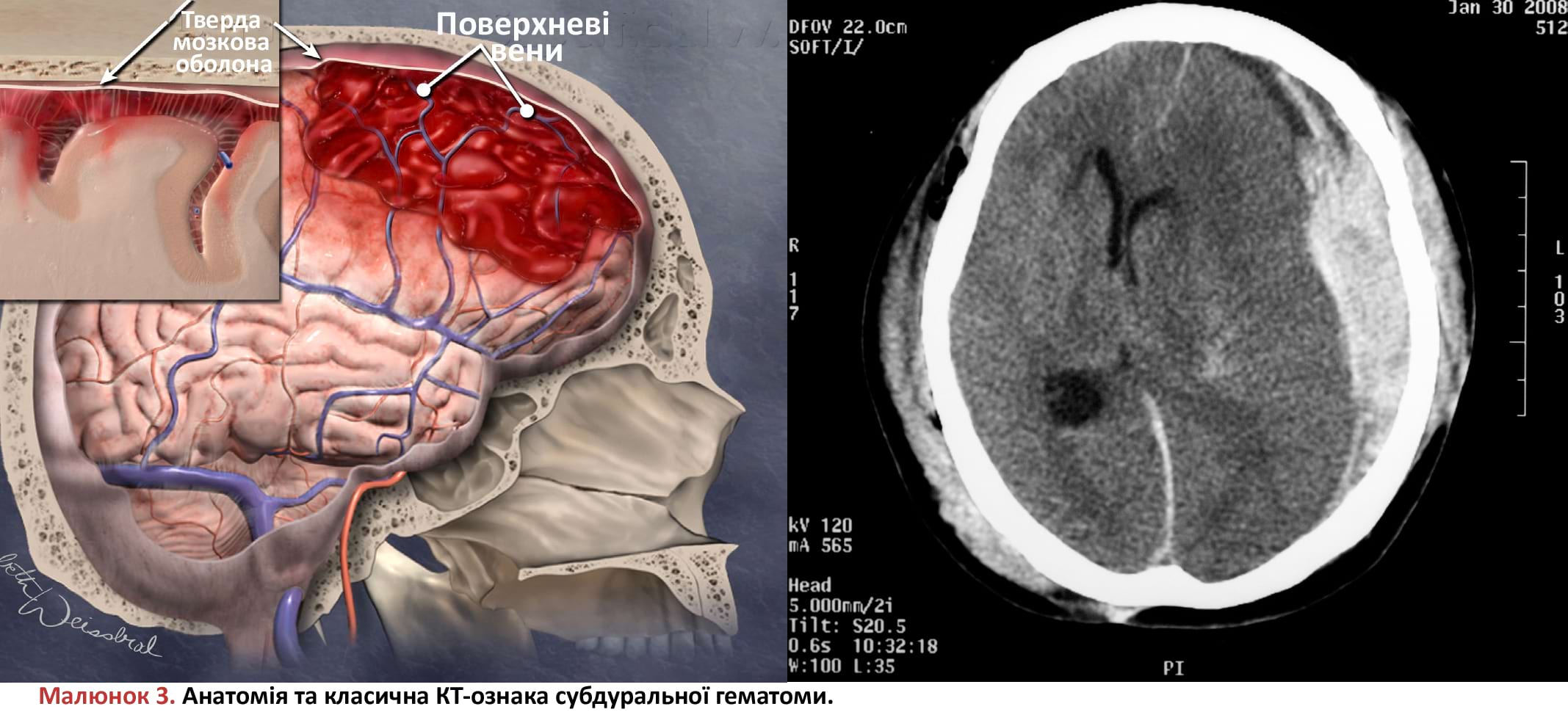 Анатомія та класична КТ-ознака субдуральної гематоми