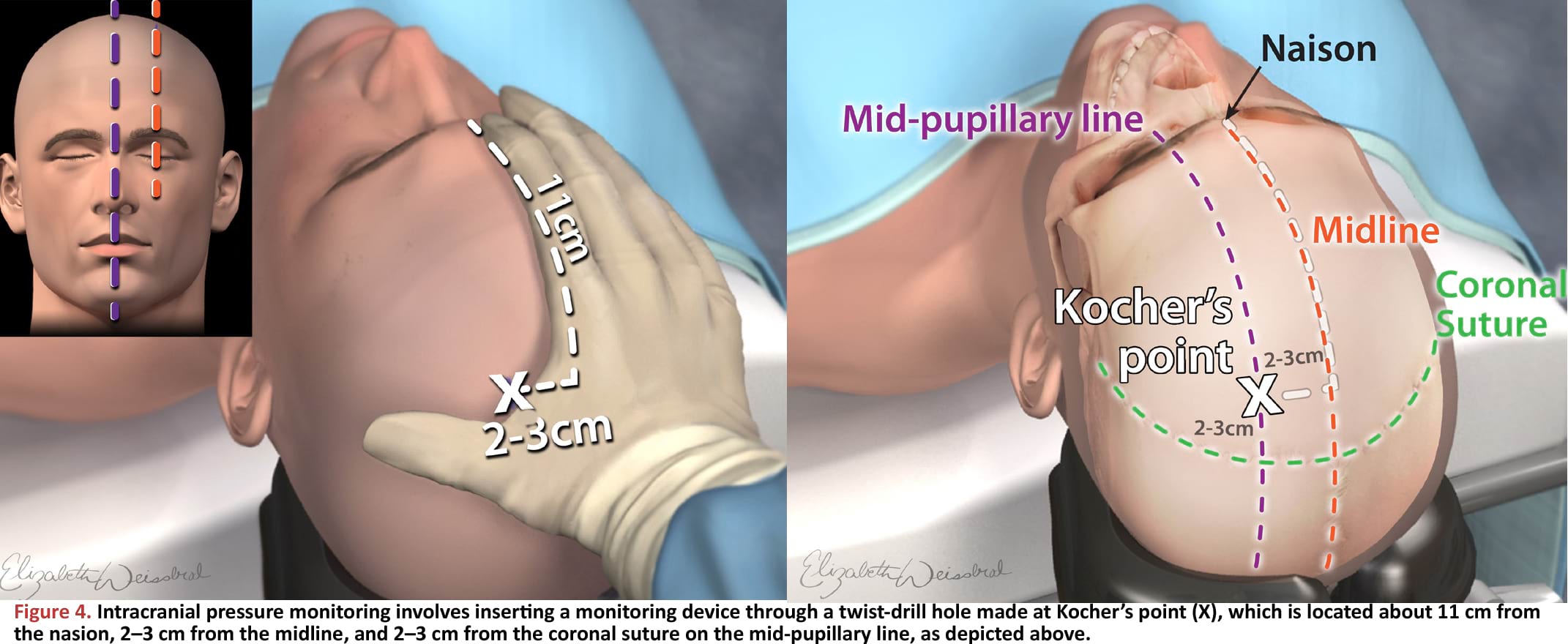 Intracranial pressure monitoring