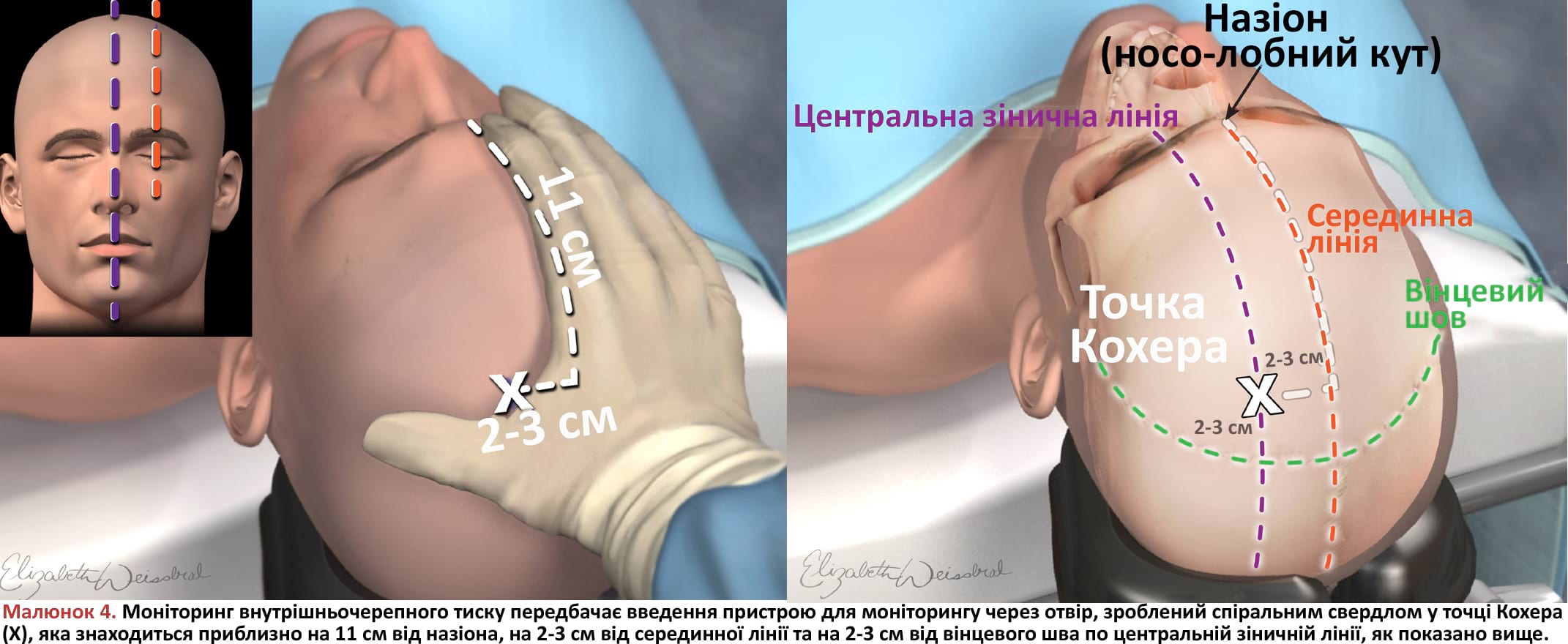 Моніторинг внутрішньочерепного тиску