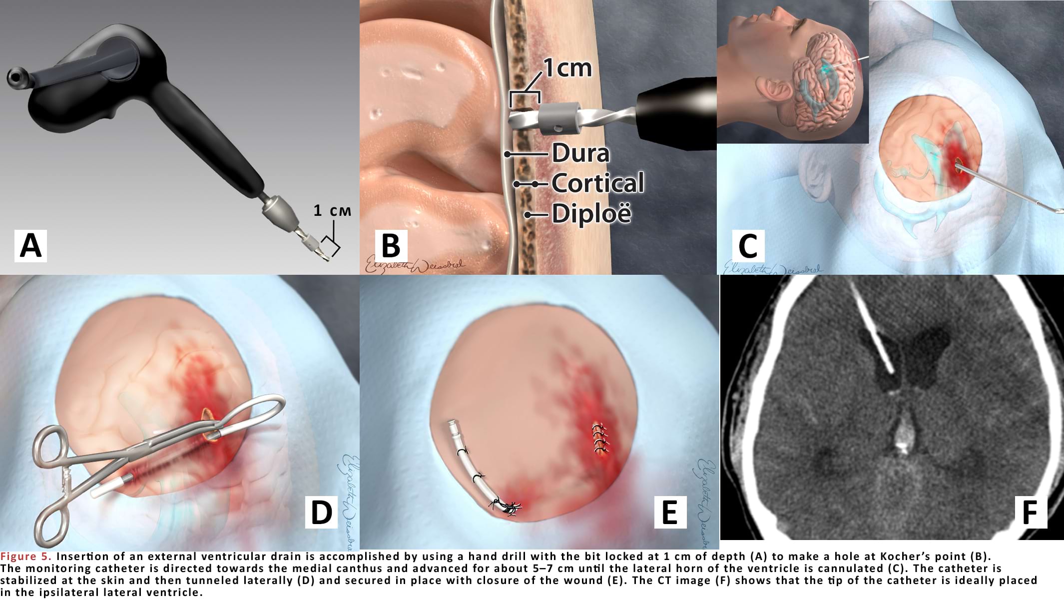 Insertion of an external ventricular drain is accomplished by using a hand drill with the bit locked at 1 cm of depth to make a hole at Kocher’s point